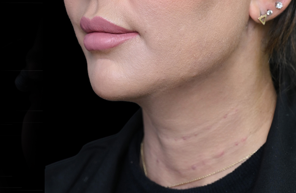 Treatment by Dr. Batoul Reffai