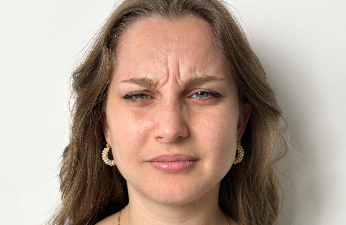 Before botox treatment