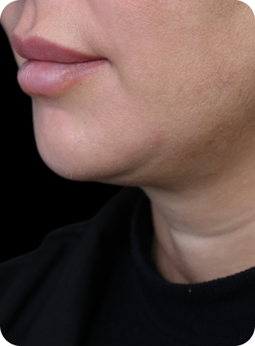 Before chin sculpting treatment