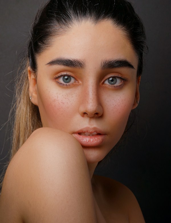 Before eye rejuvenation treatment